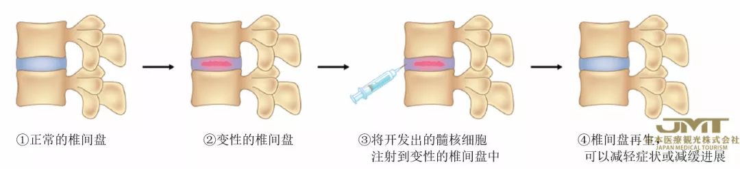 JMT日本医疗-腰痛的新型治疗方法—利用椎间盘的再生医疗技术进行治疗①