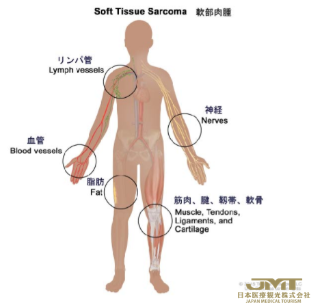 JMT日本医疗——儿童软组织肉瘤的症状及诊断①