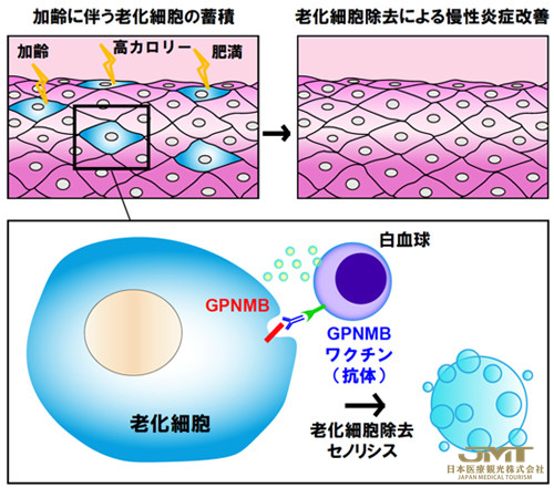 JMT日本医疗——顺天堂大学成功研发出消除老化细胞的疫苗，有望用于阿尔茨海默症的治疗