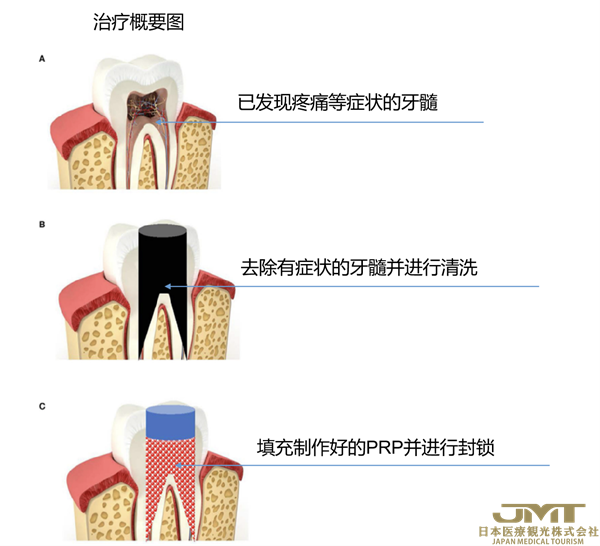 JMT日本医疗——利用自体富血小板血浆进行再生牙髓治疗