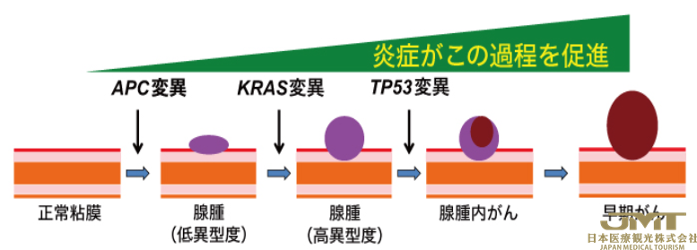 JMT日本医疗——阿司匹林对家族性大肠腺瘤症的效果验证①